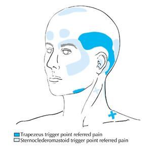 Trigger Point Dry Needling (TDN) - Boulder Therapeutics